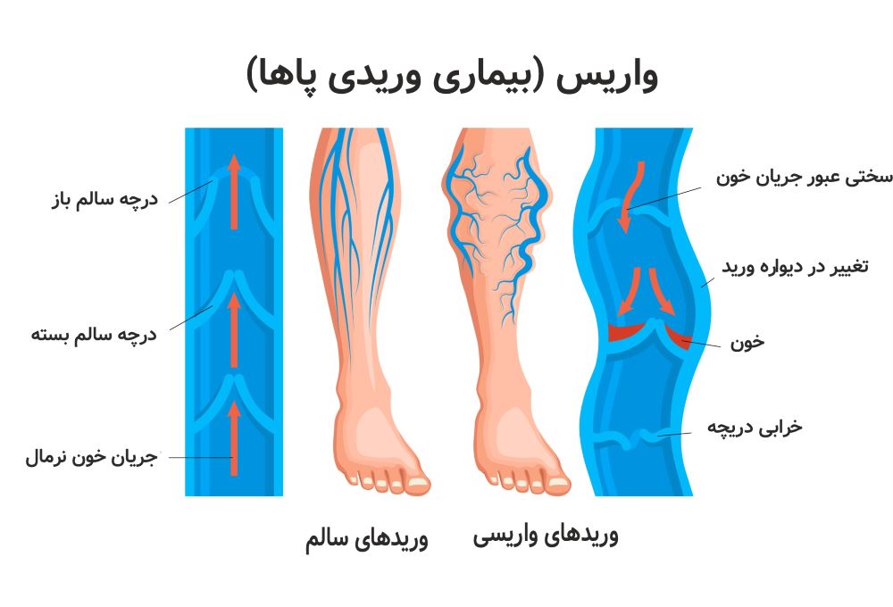 درمان قطعی و گیاهی واریس پا؛ از روغن‌های جادویی تا دمنوش‌ها